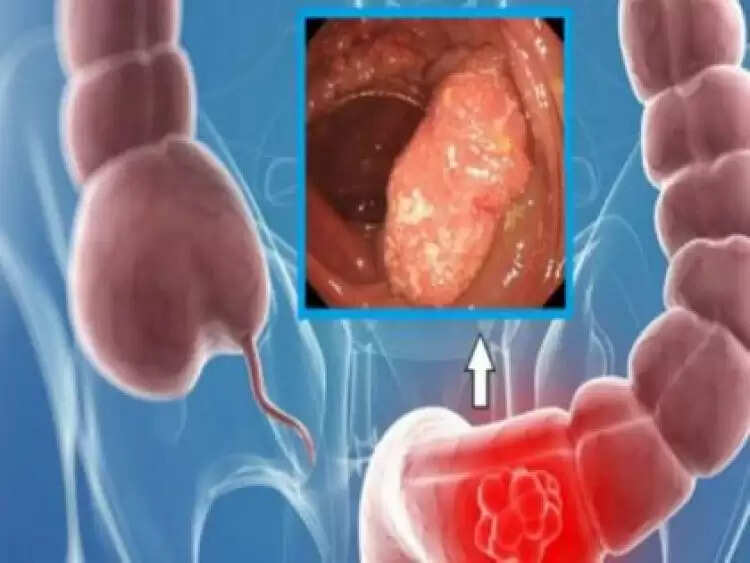 आंत में घाव अल्सरेटिव कोलाइटिस में आराम पाने के लिए
